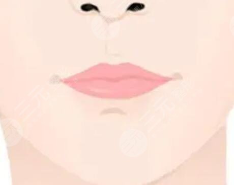 m唇手術(shù)恢復(fù)過程