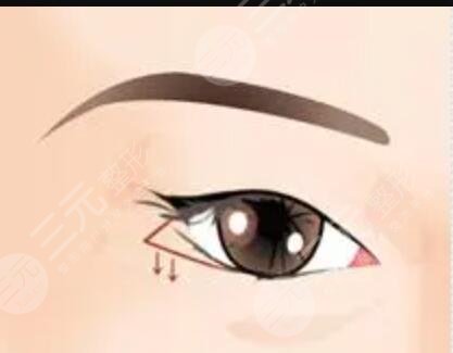 趙成利雙眼皮修復(fù)術(shù)前