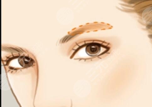 洗眉術(shù)后2天