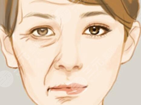 伊w蘭去皺果怎么樣？伊w蘭去皺術(shù)后對(duì)比照1