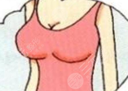 自體脂肪豐胸果對(duì)比|武侯黃氏百佳整形反饋