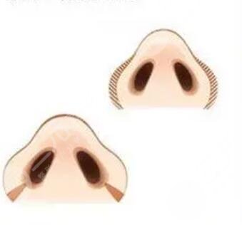 成都素美李建剛隆鼻果怎么樣？附案例真實(shí)反饋