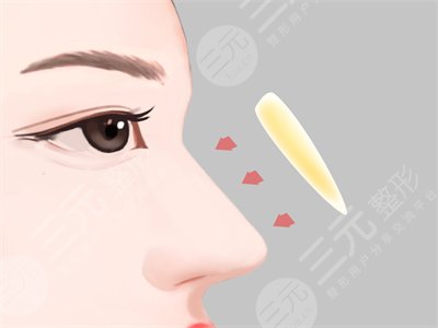 成都素美李建剛隆鼻果怎么樣？附案例真實(shí)反饋