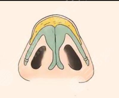 四川晶膚整形果好？誠意分享假體隆鼻術后驚艷對比