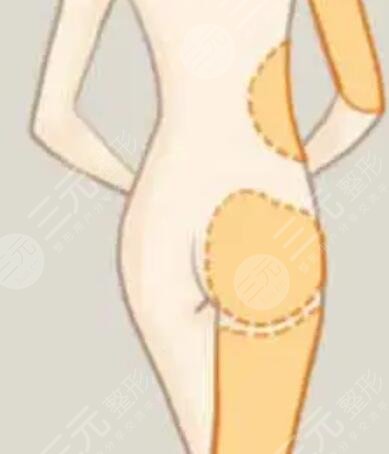 溫州星范吸脂貴不貴？誠享吸脂瘦腿術(shù)后恢復(fù)過程