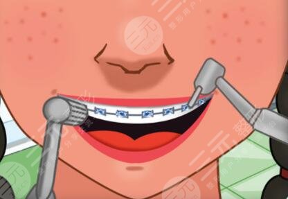 地包天矯正前后對比照片