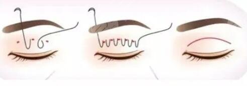 華西醫(yī)院肖海濤雙眼皮手術(shù)價格及真實果圖