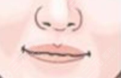 豐唇手術前后對比照片