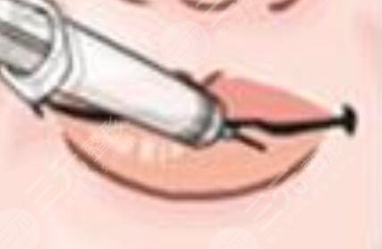 豐唇手術(shù)后照片一個(gè)月