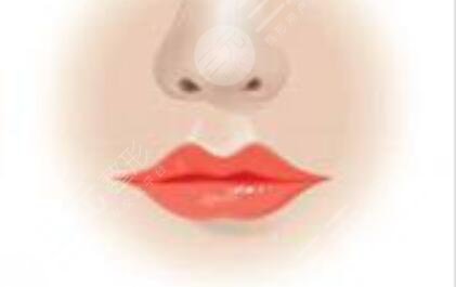 豐唇手術(shù)后照片三個(gè)月