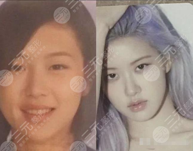 BLACKPINK樸彩英(Rosé)整容了?