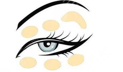 深圳陳芝醫(yī)生雙眼皮修復(fù)案例