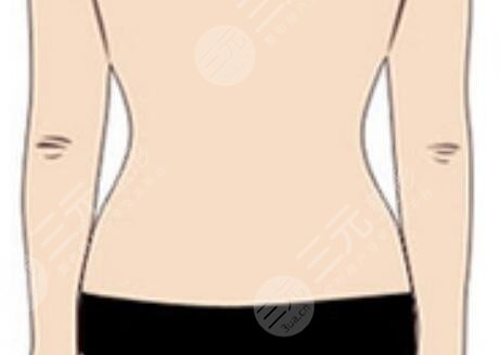 超脂塑溶脂術后會出現(xiàn)凹凸不平的現(xiàn)象嗎