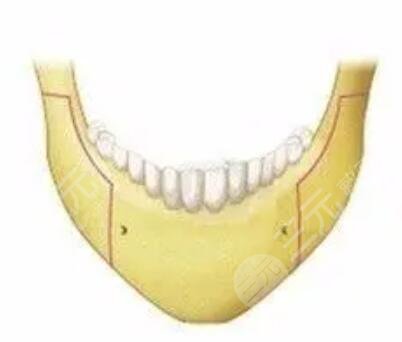 年前做的大腿吸脂塑型，現(xiàn)在有點后悔做腰部的吸脂