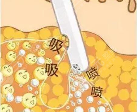 腰部環(huán)形吸脂圖片展示，擁有漂亮的小蠻腰！