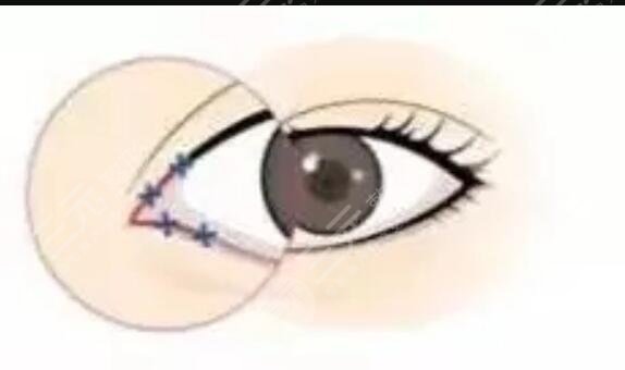 埋線雙眼皮七天恢復(fù)圖