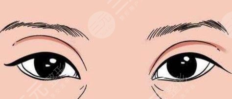 雙眼皮術(shù)后10天