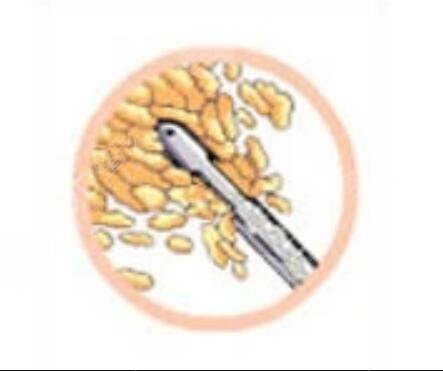 火鳳凰面部溶脂日記：跟煩人肉肉臉說byebye~