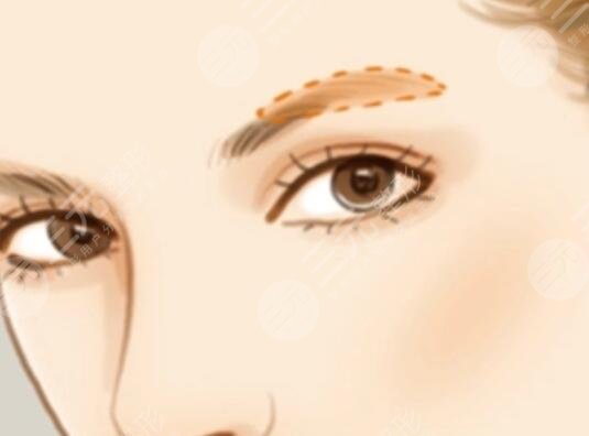 激光洗眉過程詳情