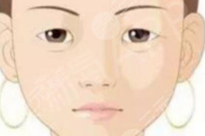 外切眼袋手術(shù)1--10天圖片