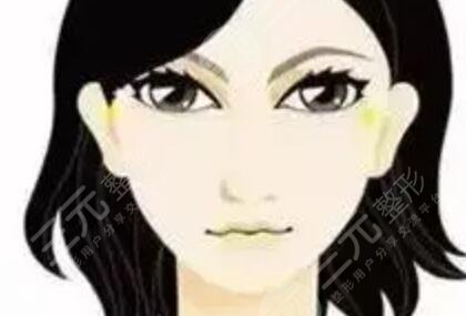 眼窩填充術(shù)后10天