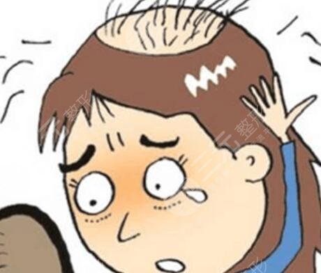 植發(fā)500個(gè)單位能有多大面積呢？看看真人案例圖！