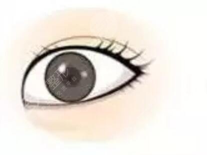 全切雙眼皮1個月恢復圖片