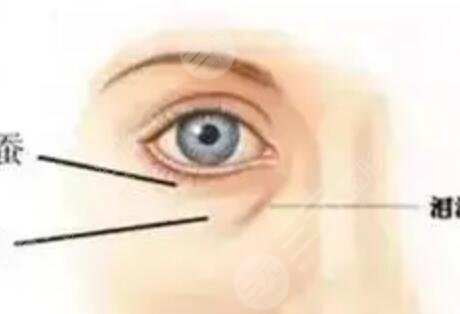 外切眼袋7天恢復(fù)圖