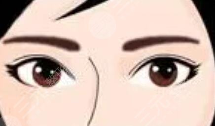 激光洗眉術(shù)前