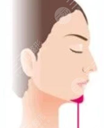 四川嬌點(diǎn)姜宇綠下頜角截骨怎么樣？手術(shù)過程恢復(fù)記錄！