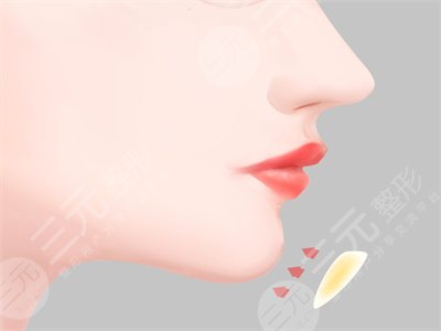 四川嬌點(diǎn)姜宇綠下頜角截骨手術(shù)之后的一個(gè)月