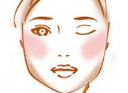 四川嬌點(diǎn)姜宇綠下頜角截骨手術(shù)之后的1年