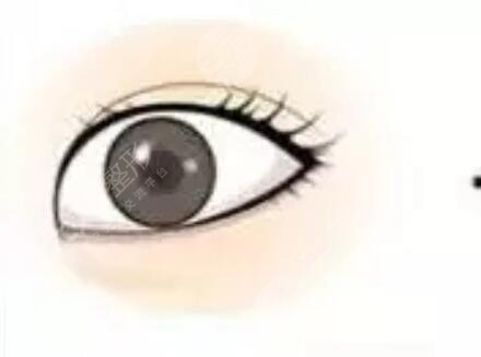 開眼角手術(shù)之后的三個月