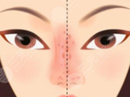 廣州荔灣人民醫(yī)院鼻子整形果圖