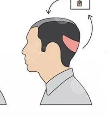 長春中西醫(yī)結(jié)合醫(yī)院微針植發(fā)怎么樣