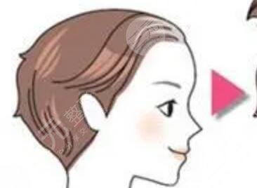 ?？谌A美植發(fā)醫(yī)院微創(chuàng)植發(fā)手術(shù)案例分享