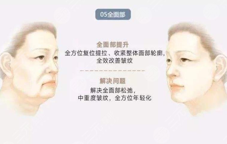 穆寶安v美減齡能保持多久?10年?術(shù)前準(zhǔn)備+術(shù)后護(hù)理盤(pán)點(diǎn)!