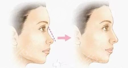 洛陽中心醫(yī)院徐永飛隆鼻案例