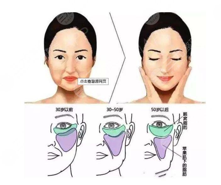 v美減齡后遺癥|輕微浮腫別擔(dān)心!手術(shù)原理+術(shù)后護(hù)理盤點(diǎn)~