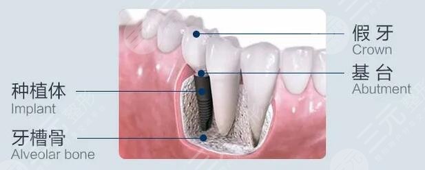 牙齒種植果好不好?