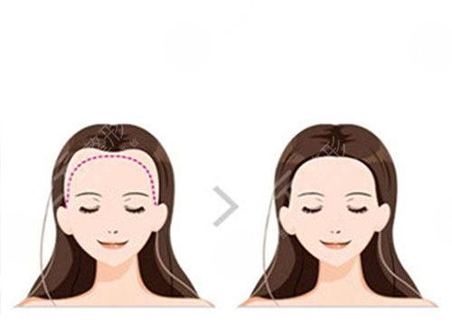 濟南雍禾醫(yī)院大面積植發(fā)緩解經(jīng)歷分享