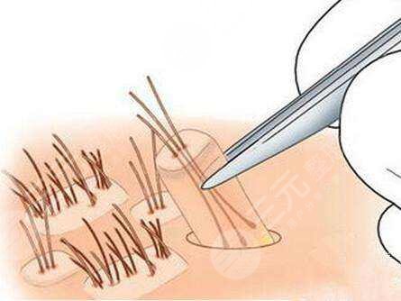 溫州大麥微針植發(fā)醫(yī)院脫發(fā)種植經歷分享