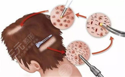上海大麥微針植發(fā)醫(yī)院發(fā)際線植發(fā)案例分享