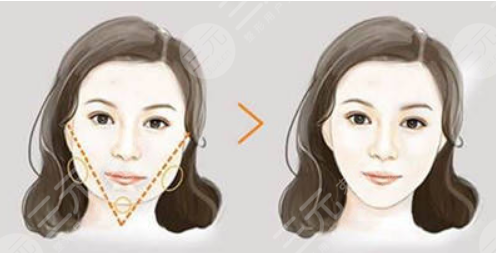 李志海磨骨成好嗎