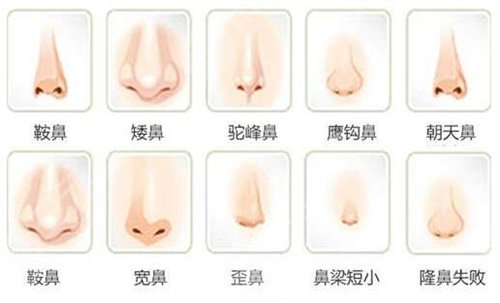 郭志輝醫(yī)生鼻部手術(shù)案例分享