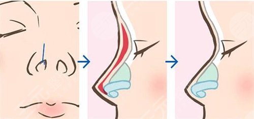 范元濤醫(yī)生做鼻子怎么樣|案例