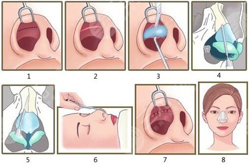 南昌易陽(yáng)艷做鼻子鼻部手術(shù)案例:術(shù)前