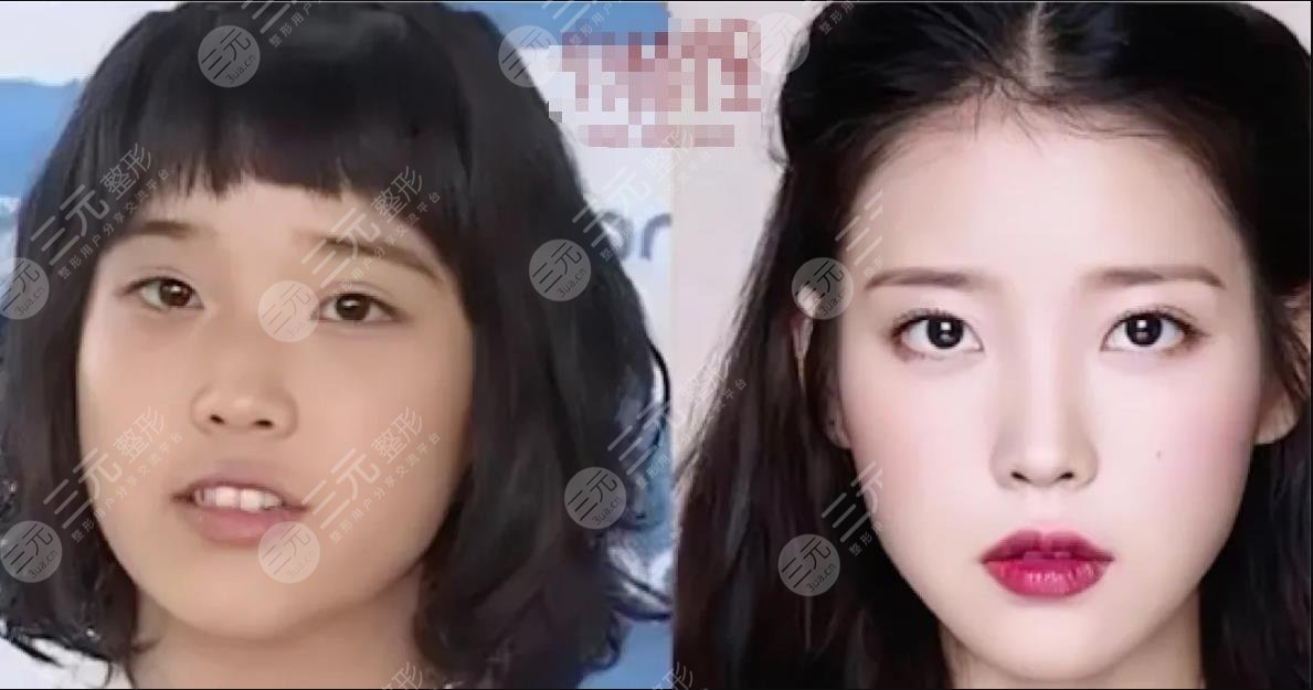 顏值分析|IU李知恩變美思路？不動骨微調(diào)也能變女神！整容史盤點！