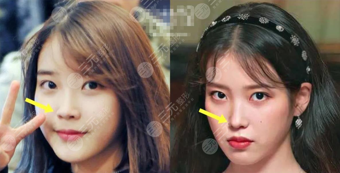IU臉上動過哪些地方?