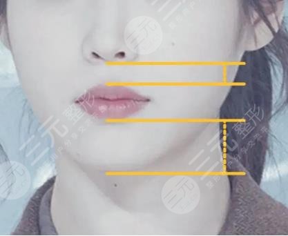 IU臉上動過哪些地方?